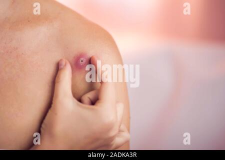 Donna cerca di schiacciare bollire sulla sua spalla. La gente, la medicina e la cura della pelle concept Foto Stock