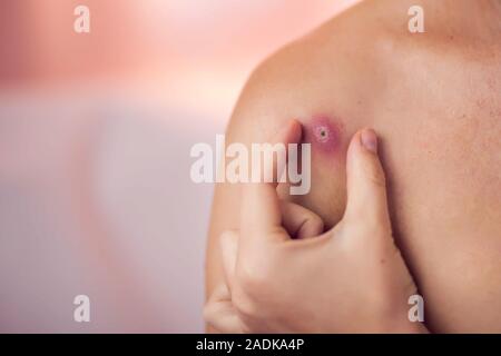 Donna cerca di schiacciare bollire sulla sua spalla. La gente, la medicina e la cura della pelle concept Foto Stock