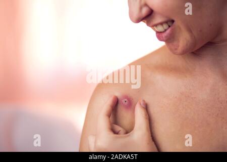 Donna cerca di schiacciare bollire sulla sua spalla. La gente, la medicina e la cura della pelle concept Foto Stock