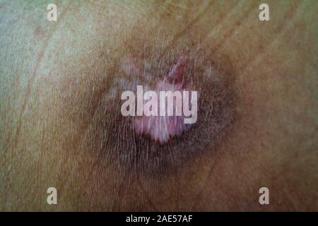 Terribili piaghe da decubito con terribili ferite mal di pressione sulla pelle di un malato Uomo sdraiato senza il movimento di un uomo vecchio Foto Stock