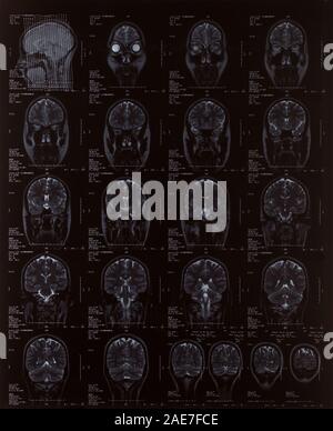 MRI scan - Sequenza di sezioni verticali di una femmina di cervello umano Foto Stock