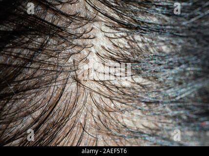 Uovo di pidocchio sui capelli provoca prurito testa. Foto Stock