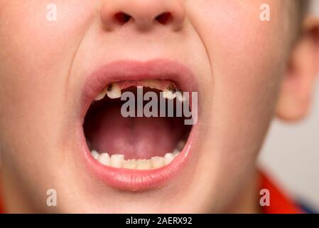 Kid paziente aperto bocca che mostra le cavità dei denti di decadimento. Close up malsana baby denti. La medicina dentale e della sanità. Foto Stock