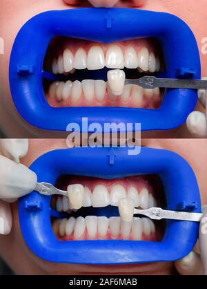 Procedura per confrontare le sfumature di colore dei denti dopo lo sbiancamento Foto Stock