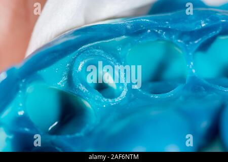 Preparazione di un dente umano per la fabbricazione di corone, impronta dentale. Close-up macro Foto Stock