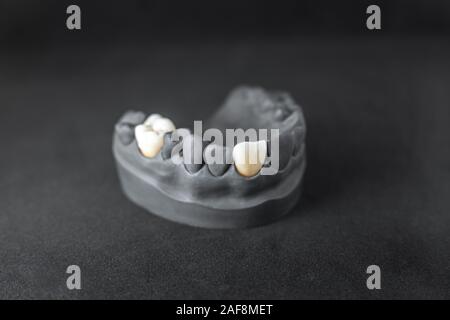 Close-up sul modello in gesso del dipinto in nero ganascia artificiale con corona impianto su sfondo nero. Concetto di odontoiatria estetica e impianto Foto Stock