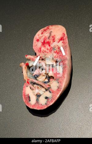 Präparat, Plastinat, krebsbefallene Niere , Menschen Museum di Berlino, Deutschland Foto Stock