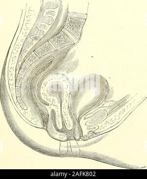 . La diagnosi di una patologia e il trattamento delle malattie delle donne compresa la diagnosi di gravidanza. in retroflexion. Gli aborti sono molto comrfion in casesof retroflexion, l'utero di espellere l'uovo in corrispondenza di un molto presto * Fig. 72 rappresenta un tumore fibroide crescente dal retro dell'utero.le pareti della vescica sono qui reso troppo spesso. Le flessioni e le versioni di utero. 515 periodo. Quando la cellula uovo è trattenuto, il Fundus è ora e thennaturally elevata in una posizione corretta come la gravidanza avanza,ma più frequentemente guida artificiale è necessario. Molti casi ofpregnancy con retroversione dell'ut Foto Stock