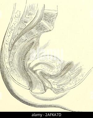 . La diagnosi di una patologia e il trattamento delle malattie delle donne compresa la diagnosi di gravidanza. teflexion. In flessione laterale del collo dell utero, morerare, ma non così rara come è stato supposto, la piegatura di theuterus generalmente non è considerevole in grado. Le flessioni e le versioni di utero. 509 flessione dell'utero possono esistere puro e semplice. È anche, come sempre, molto spesso associata con la presenza di growthsin fibroide uterino del muro, del tipo e del grado di flessione varyingaccording alla posizione del tumore. Il fundus della uterusis prontamente piegato un po' indietro Foto Stock