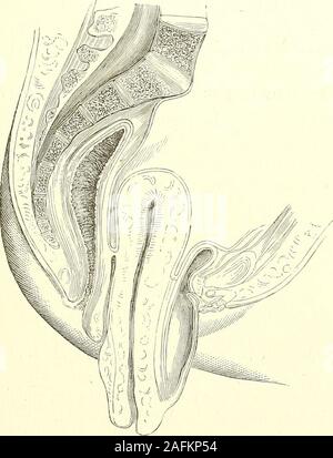 . La diagnosi di una patologia e il trattamento delle malattie delle donne compresa la diagnosi di gravidanza. dell'ex. (Fig. 18 rappresenta un bene-markedcase di questo tipo, le misure prese in modo accurato. Il patienthad aveva figli.) In modo simile, il retto è responsabile, ma in grado di aless, per essere prolapsed con il loAver parte dell'utero ; eil risultato è che nei casi di estesi prolapsus della cervice, tumori al OS UTERI. 215 -Se con o senza ipertrofia della parte, vi è un softtumor davanti-vescica e una più piccola dietro-rec-tum-tra cui due os uteri Foto Stock