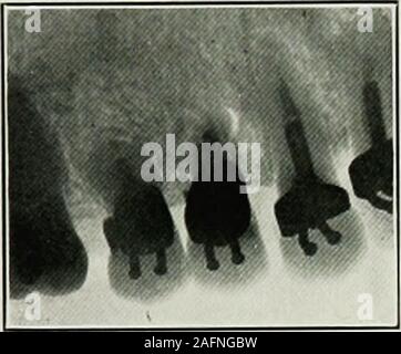 . Dental elettro-terapeutici. Fig. 88 Fig. 89 FIGG. 88 e 89. Casi di assorbimento in connessione withalveolar ascesso. Fig. 90 mostra superiore sinistra della prima e seconda bicuspids takensix anni dopo amputazione delle radici. Entrambi i denti impresa andsurrounding tessuti sani. Fig. 91. Caso di fistola superiore destro incisivo centrale,portante un perno dente, e accompagnate da ampie lossof la struttura ossea. Amputazione di Apex è stato fatto ricorso a.Fig. 92 mostra l'estremità di radice perso in ascesso cavità durante l opera- GLI USI DEI RAGGI X IN ODONTOIATRIA 177 zione. Fig. 93 mostra la condizione dopo amputazione. Fig. 94.caso un anno Foto Stock