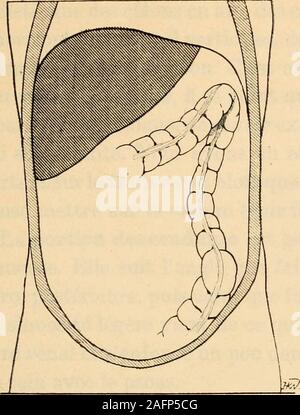 . Anatomie médico-chirurgicale de l'addome. Fie. 5i. - Disposizioni différentes du côlon suivant trasversale que le thorax est grande étroit ou. XVIII. Pagina 146. R. Grégoire. Planche XLIV (pagina 147).. Foto Stock