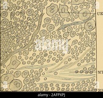 . Analisi delle vie urinarie e la diagnosi da microscopiche e l'esame chimico. PE. MT HB Fig. 125.-Acttte ascesso della ghiandola prostatica (X 500).RB, rosso sangue-globuli; PC, pus-globuli; PE, epiteli dalla ghiandola della prostata;DP, epiteli dai condotti della ghiandola prostatica; UE, epiteli dall'uretra;CT, tessuto connettivo trita; MT, muco-thread; MB, epiteli dal medio layersof la vescica. Foto Stock