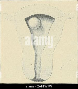 . La diagnosi e il trattamento delle malattie delle donne. * Relazione di un caso di Chorioma, da H. S. Ciosseu, M. D. e Carl Fisch, M. D. AmericanGynecology, Gennaio, 1903. La malattia maligna dell'utero circa le stesse teorie sono state portate avanti per conto di esso. Sarcomadiffers da carcinoma in che può verificarsi a qualsiasi età, anche se più frequentfrom 40-60, e inoltre non è particolarmente associato con il bambino-cuscinetto. Il sarcoma può apparire come un gen erale di infiltrazione del endome-trium o come un tumore distinti.dal cambiamento edematosa, uva-likemasses possono formare, sia nella sar-coma dei cervi Foto Stock