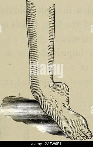 . Un manuale pratico del trattamento di club-piedi. Hattie B., maggio 1873.-azionato dopo settembre 30,1870. L'operazione aveva partecipato con così muchdanger, che io mi sono rifiutato di operare sulla otherfoot fino alla sua salute generale potrebbe essere migliorato.ha quindi lasciato la città per Leroy, New York,dove rimase per due anni, muoversi a casi. 107 sulle sue stampelle e recanti il suo intero peso sullato Sayre piede (come ha chiamato) senza anypain; ma l'altro piede era completamente inutile, andvery doloroso alla minima pressione. Tornò in maggio di 1873, molto migliorata ingeneral salute, Foto Stock