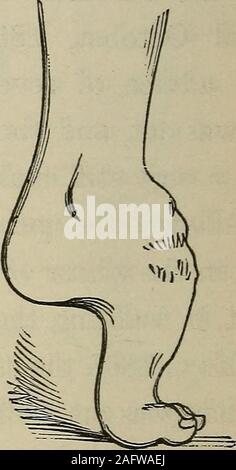 . Un manuale pratico del trattamento di club-piedi. Agosto 17th.-piede ancora resistito attemptsat raddrizzatura. Di conseguenza ho diviso il integ-uments nella suola del piede premuto forzatamente thetarsal le ossa nella posizione corretta con la mano, andbroke fino le adesioni in la pianta del piede. Piedi è stato poi fermamente bendato per una scheda con dsupporto grande comprimere di lana sopra il collo del piede. L'oper-zione è stata seguita da alcune reazioni febbrili whichhad scomparso il giorno seguente. Casi. 91 Il 1 settembre 1868.-Il progresso è stato ONU-interrotta poiché l'ultima operazione; sebbene thewound nel Foto Stock