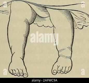 . Un manuale pratico del trattamento di club-piedi. porta dipartimento di Bellevue Hospital, novembre7, 1867, sotto la cura di Dr. W. H. giovani. Parentshealthy ; n. altri bambini. Trattamento mediante elastictubing (vedere pagina 48). Il piede destro è stato dressedNovember 11th, il piede essendo abbastanza facilmente broughtround e trattenuto in posizione diritta. !Nb- 1 perfettamente recuperato in meno di due anni. casi. 79 vember 15th, condimenti hanno dato alcun dolore o ONU-facilità per il bambino. Riapplicato dal dottor Sayre. 20th,-deformità del piede destro circa una metà;medicazioni applicate al piede sinistro per giorno, che è retainedin pos Foto Stock