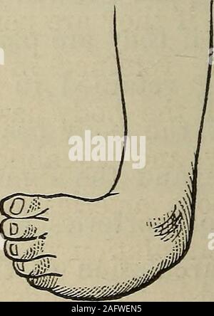 . Un manuale pratico del trattamento di club-piedi. Afferrando il piede in una mano e la legin gli altri, ho potuto con qualche notevole sforzo,continuò per un paio di minuti, rovesciare il piede, andslightly flex. La circolazione capillare seemedto essere arrestato completamente quando ho fatto questo e il footbecame bianca come la neve. Dopo aver premuto in thisposition pochi minuti, vorrei rilassare la mia attesa, casi. 67 quando il piede dovrebbe riprendere immediatamente la sua abnor-mal posizione e in un breve periodo di tempo pratica wouldreturn ad esso come al primo. Ho poi eseguita la stessa operazione sugli altri piedi. Dopo repeatin Foto Stock