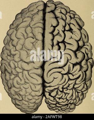 . Un trattato sulle malattie del sistema nervoso dei bambini, per medici e studenti. mal sviluppo mentale. Se la de-fect è nel motore aree, disturbi del movimento e ofsensation sarà naturalmente sottolineare la zona difettosa. Whileporencephaly è estremamente frequenti in questa regione, ho havenot ancora visto un unico cervello che mostrava il normale sviluppo delle sue fessure e le circonvoluzioni in tutti ma il motorregion. Sviluppo difettoso del lobo occipitale.-sviluppo difettoso del lobo occipitale, come indicato dauna atrofia del gyri di questo lobo, è ben illustrato da thecase rappresentata Foto Stock