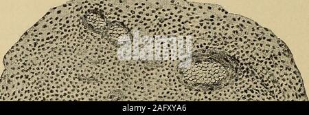 . Un trattato sulle malattie del sistema nervoso dei bambini, per i medici e gli studenti. ?••::, Da ^*"^-^0 ^:;;?-.;&GT;:" Fig. 65.-disseminata acuta Mielite. F, foci di piccole dimensioni contenente le cellule rotonde generallyclustered sui vasi sanguigni. van Gieson stain (dopo Oppenheim).. Foto Stock