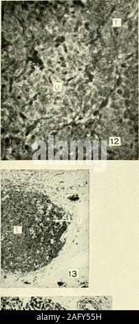 . Il giornale americano di anatomia. ht è solo parzialmente incassati nella ghiandola tiroidea e contiene manycystoid follicoli (C.I^.)che non contengono colloide e qualche piccolo follicleswhich contengono colloide (Co). I puntini neri nella porzione della figura labeledthyroid rappresentano colloide. Sinistra ultimobranchial corpo è più profondamente im-bedded in thj-roid premistoppa. Da un embrione di 125 mm. a lungo. X 38. 17 da una fotografia di una porzione di una sezione trasversale del viaggio:.rtitecomplex mostra il diritto ultimobranchial corpo nel quale si trovano sia piccole cistoidi follicoli che contengono colloide. Foto Stock