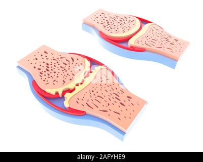 3d illustrazione di sano sinoviale e congiunto con l'osteoartrite. Immagini isolate su sfondo bianco appoggiato sul pavimento. Colori vividi. Foto Stock