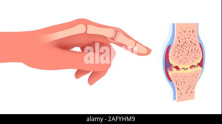 3d illustrazione del giunto sinoviale con osteoartrite. Accanto alla rappresentazione grafica di una mano posizionando il giunto. Foto Stock