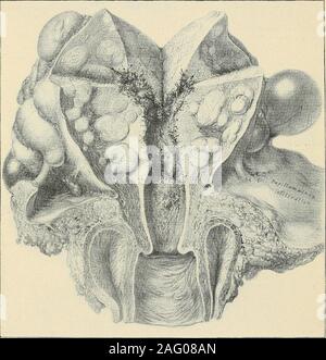 . La diagnosi e il trattamento delle malattie delle donne. t. Le caratteristiche di questi hanno alreadybeen dato. Vi possono essere in via eccezionale sia carcinoma e fibroide (Fig. 421). 2. Gravidanza addominale e Lithopedion (Figg. 422, 423, 424). 3. Tumori solidi di omento, intestino tenue o mesenterica. Questi usuallyappear vicino alla linea mediana e le indicazioni variano con la posizione. La diag-nosis poggia sulla presenza di una massa presentante i sintomi e segni tobe previsto in un tumore da una di queste strutture e per il quale non più-commondisease sarebbe account. Tali tumori sono solitamente accompagnati b Foto Stock