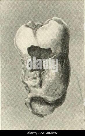 . La scienza e la pratica della chirurgia dentale. La fio. 553.-Rarefying periodontite. Modello di .il lato sinistro del amandible che mostra il secondo molare impattato tra laprima e terzi molari. 1898-9, contro un altro, e talvolta si verifica in anupper incisivo laterale al momento dell eruzione del canino, o nella radice distale di un secondo molare 498 attraverso l'impatto del terzo molare.Per la maggior parte l'assorbimento è causato da chronicapical ascesso, e si verifica di frequente in instanceswhere root-ripieni o affronta sono stati ammessi reanain sporgente oltre l'apice di un dente. Fig. 554. - Kanfyint; Foto Stock