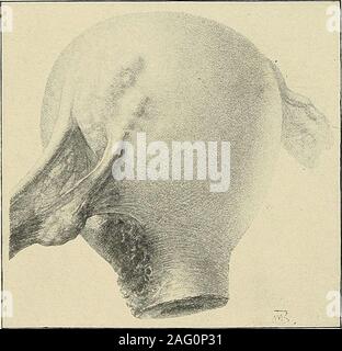 . La diagnosi e il trattamento delle malattie delle donne. Fig. 376. Unico grande leiomioma in anteriore della parete uterina, parzializzando la Fig. 377. Grandi fibromi, riempimento del bacino e il bacino. (KeUy-Operative Gi/necolngy.) abbassare l'addome. (A-Msirtin-Atlas di ginecologia.). Fig. 378. Utero ingrandita dal carcinoma. In terior dell'utero è occupata dalla crescita e hasextended attraverso la formazione di alcuni noduli sulla superficie esterna. CKeWy-ginecologia operativa). Foto Stock