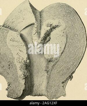 . La diagnosi e il trattamento delle malattie delle donne. Fig. 358. Un singolo leiomioma,tlie nella parete posteriore dell'utero. (Byford-Manual di ginecologia.). Fig. 359. Lieve Ampliamento del Corpus Uteri causato da un carcinoma.(Cullen-cancro del Utei-us.) 246 DIAGNOSI GINECOLOGICA Foto Stock
