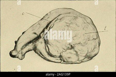 . La diagnosi e il trattamento delle malattie delle donne. Un leggero allargamento dell utero 245. Fig. 358. Un singolo leiomioma,tlie nella parete posteriore dell'utero. (Byford-Manual di ginecologia). Foto Stock