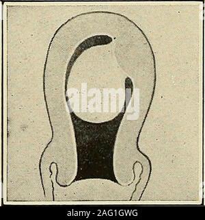 . La diagnosi e il trattamento delle malattie delle donne. Fig. 313. Inizio inver-sion dell'utero. Fig. 314. Submucous Fib-roid con breve peduncolo. Foto Stock