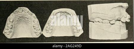 . La scienza e la pratica della chirurgia dentale. Fig. 377.-ritratto del caso illustrato in Fig. 376.Compare con Fig. 375 e nota la cliange nel profilo delcarrello dento-area facciale. ganascia deve essere mantenuta proporzionalmente più ex-panded di quelli a basso er ; questo w ill portare il medio-occlusione distale dei primi molari corretto quandoil bucco-linguale rispetto è giusto. Da trattare-mento in questo w ay il basso er ganascia può essere expectedto spostare in avanti senza l'applicazione del. Fig. 378.-Casi- prima del trattamento. Procedere in questo modo da molto piccole fasi in modo asnot a disturbare la masticazione. Se, alla fine del trattamento e Foto Stock