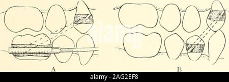 . La scienza e la pratica della chirurgia dentaria. bow deve. La fio. 302.-Tlie lato sinistro nella figura A, mostra il movimento del primo upperpremolar distalmente per mezzo di inter-mascellare forza applicata da lavite della ganascia (semplice di ancoraggio). Lato destro in figura, B, showsmovement del canino superiore in senso distale e della parte inferiore della prima premolarmedially (ancoraggio reciproco). Le bande di gomma sono attaccati ai contrafforti o bande di pianura, tranne nel casodi il molare, quando l'estremità distale del tubo boccale viene utilizzato. (Iii) la ganascia inferiore. 29. Gli apparecchi fissi. (Ajipliances rimovibile non sono applicabili.): ancoraggio la opposin Foto Stock