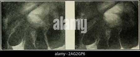 . Dental elettro-terapeutici. Fig. 87 mostra un interessate inferiore sinistro secondo bicuspidwith deciduo secondo molare. Dopo estrazione di thelatter e la separazione del primo molare e primo dente biseupidthe assume la sua normale posizione, Fig. 88. Un buon skiagraph stereoscopica è spesso di considerablevalue in ortodonzia, ma sebbene un buon lavoro è stato donein questa linea, non vi è ancora, come è stato detto prima, toomuch diversità di opinione per quanto riguarda la distanza corretta in cuiè tubi devono essere poste su ciascun lato della linea mediana,per consentire ad un operatore di seguire un metodo standard di ex-posure, Foto Stock