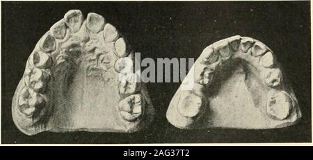 . La scienza e la pratica della chirurgia dentale. Fig. 208.-retrusion inferiore (mezza unità), e secondario ofupper proclination incisivi, associato con ampie arcate. (Norman G. Bennett.) 126, tuttavia le informazioni sembra essere wantingwith relativamente alle normali condizioni in diverse. Foto Stock