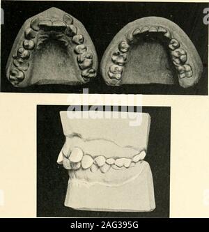 . La scienza e la pratica della chirurgia dentaria. b IG. 204.-tipico caso di retrusion inferiore e secondaria superiore retrocliiiationof incisivi centrali. L'occlusione del tlio molari è normale, butthis è causata da perdite o non-eruzione della seconda torre premolarsand movimento in avanti dei molari inferiori. Tutta la mandibola è post-normale (retrognatliism). (Norman G. Bennett.) è il caso nella maggior parte delle anormalità lordo involvingthe ganasce stesse. Questa vista è vistato byJ. H. Badcock (12). D'altro canto, la maggior parte la Fio. 2().&GT;. -Retrusion inferiore (una unità) e secondaryretrochnation della centrale superiore Foto Stock