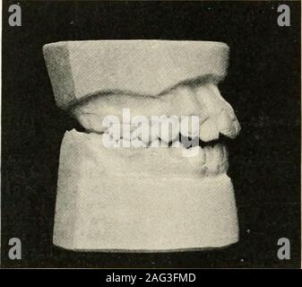 . La scienza e la pratica della chirurgia dentaria. Questo uifluence, mentre la porzione anteriore del themandible è mantenuto premuto dall'hyo-mandi- bular muscoli, theposterior portionis constantlyforced verso l'alto dail andinternal masseteri pterygoidmuscles e sothe obliquità ofangle associatedMith il earlyyears della vita ismaintained. Itwill essere percepito. Foto Stock