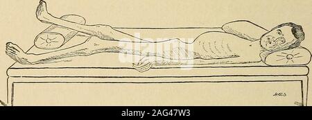 . Un manuale di malattie del sistema nervoso. omes un sintomo caratteristico.f i bracci sono solo invaso, intimo casi, alcuni anni dopo le gambe, in modo lento è il corso di thedisease. L intrinseca i muscoli delle mani (thenar, hypothenar,e interosseal muscoli) vengono dapprima attaccato, e successivamente quelli dell'avambraccio: talvolta il extensors e talvolta flessori sufferfirst e più; mentre il supinator longus rimane normale e così dothe muscoli delle spalle, collo e schiena. L'affetto, tuttavia,non necessariamente iniziare agli arti inferiori e il volto forse colpiti (Hoffmann Foto Stock