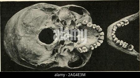 . La scienza e la pratica della chirurgia dentale. La fio. 9=o.-naturale di allargamento di arch dopo la rimozione ofadenoids. A, A secondi molari. (J. G. Turner :Brit. Dent. Jour.) è stato sottolineato che la crescita avviene inperiods e sezioni, e Turner ha shownexamples per illustrare come la crescita di un por-zione della ganascia mentre adenoidi esistito wasdefective e rimasto così, sebbene altri Fig. 100.-naturale di allargamento di arco nella regione di secondmolars. Età, circa 14 anni. Adenoidi wereremoved successivamente. (Norman G. Bennett.) sviluppato senza l'esistenza delle adenoidi,e anche se è vero che il pos Foto Stock