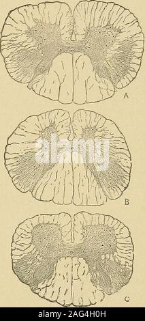 . Un manuale di malattie del sistema nervoso. rhaps il leastdangerous alla vita di qualsiasi malattia chronicspiaal. Anche problemi secondarykidney scarsamente mai oc-curs; forse eccessivo di ri-flex azione può salvare il bladderfrom pratiche pregiudizievoli di over-distensione.It è quando gli altri elementi della corda che soffrono dangerouscomplications derivarne. PATHOLOGICAIi AkATOMT.-In fatto appena dichiarato probablyhave abbiamo una spiegazione del silenzio di anatomia patologica sul tema ofuncomplicated sclerosi laterale. Nee silet mors, apt il motto della Società thePathological, è vero soprattutto di malattia che uccide. Completedegene Foto Stock