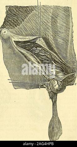 . I principi e la pratica della chirurgia moderna. parti legamento. c. Allegato pubica del tendine del obliquo esterno. d. Obliqua interna, parzialmente sollevata per mostrare la transversalismuscle. e. Muscolo Transversalis. ss. Tendine del transversalismuscle e lo scudo trans-versalis, allungata da lapressione della erniaria tu-mor, e sporge attraversoil anello esterno. La TEN-don e la fascia transversalis sono stati mescolati in modo come notto essere distinto. Thisbag è tagliata aperta per mostrare theperitoneal sac: g. Sac peritoneale, collegato alla sacca thetendinous da cellularmembrane. Vi è fre-temente una co Foto Stock