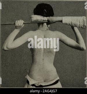 . Un manuale di esercizi terapeutici e massaggi, progettato per l'uso di medici, studenti e massaggiatori. Fig. 54.-esercizio di canna per la rotazione dei bracci. Per la scelta di queste varie forme di trattamento theremust essere considerato non solo le condizioni locali e aboutinformazioni bursa ma anche come Codman sottolinea le cause, thenervous e delle condizioni fisiche del paziente e come aggiungere wemay, le condizioni sociali e la competenza di thesurgeon o il massaggiatore. SUBACROMIAL BORSITE 227 (a) Dalla nostra esperienza riteniamo che la conservativetreatment dal graduale, stiramento passivo e attivo exe Foto Stock