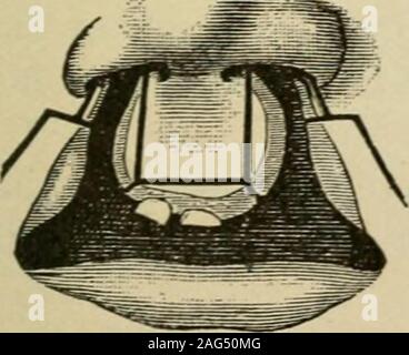 . Manuale di intervento chirurgico. FiG. 205. Fig. 206. zione dei bordi della fessura al di sotto del livello della parte centrale (G). I lembi twolower quando le loro superfici grezze vengono suturate insieme formano una preminenza sul bordo del nuovo labbro superiore. L'aspetto della ferita quando l'opera-zione è completato è rappresentato in Fig. 206. Altri metodi di funzionamento aresuflSciently illustrata dalle figg. Da 207 a 215. Foto Stock