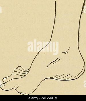 . Un manuale di malattie del sistema nervoso. La fio. 30.-Extreme talipes eqainns dal vecchio-paralisi permanente del tibialisanticus (paralisi infantile) estreme e la contrazione dei muscoli del polpaccio. Noflexor movimento era possibile. Fig. 31.-la paralisi di interossei e l'adduttore e flessore breve dell thegreat punta. Le prime falangi sono più estese e la seconda sono flesse,mentre la cavità della suola è aumentata. (Dopo la distrofia.) da attenuato la crescita delle ossa della gamba, in modo tale che la sfera del piede onlytouches il terreno quando il piede viene esteso. Di solito vi è un leggero rotationinwards Foto Stock