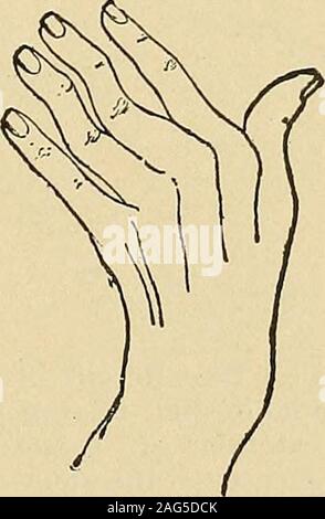 . Un manuale di malattie del sistema nervoso. Fig. 13.-la postura della mano in contrazione del palmar scudo, resemblingthat nella paralisi di lunga extensors del dito. Fig. 14. - La paralisi delle fibre del flessore sublimis che agiscono sulle dita twomiddle: dodici anni di durata. La seconda falange di questi fingersare piegata all'indietro e subluxated dalla contrattura della unopposedinterossei, mentre l'ultimo plialanges sono mantenuti in posizione dal unaffectedflexor profundus. (Dopo la distrofia.) Quando l'estensore delle dita è in forte azione estendendo la proximalphalanges, Foto Stock