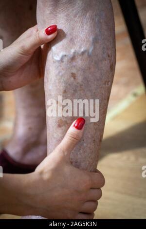 Primo piano dei piedi di vecchio uomo affetti da lebbra con una canna sul terreno Foto Stock