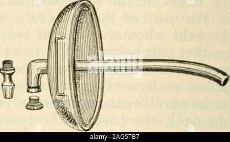 . La moderna chirurgia generale e operativa. Fig. 977.-Senns tubo d'argento. Fig. 978.-Stevensons suprapubicdrainage-tubo. Crescite nella vescica femminile.-fu a lungo la consuetudine di dilatare i urethraas in un caso di pietra e raschiare, piegare o tirare la crescita di distanza o legare it.Questo piano è inefficiente, come da esso la base del tumore non viene rimosso. È Foto Stock