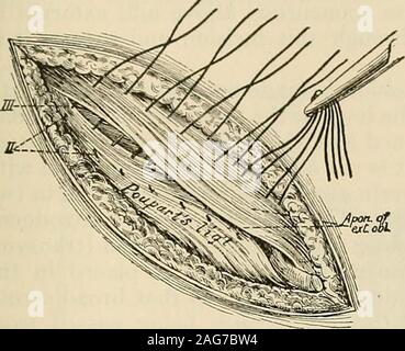 . La moderna chirurgia generale e operativa. nascosto sotto il bordo del legamento (Fig. 825). • Per ottenere questo risultato potrebbe esserenecessario rilasciare il muscolo per incisione anteriore guaina rettale. Theincision in obliquo esterno è ora chiusa con suture che si sovrappongono themargins (Figg. 826 e 827), e la ferita della pelle è inoltre chiuso. Funzionamento Halsteds Plus Metodo Bloodgoods gu trapiantando la RectusMuscle.-(vedere Jos. C. Bloodgood, in Johns Hopkins Hosp. Relazioni,vol.vii.) Quando il tendine di congiunzione è molto sottile o obliterato, ordinaryoperation non è sufficiente. Insufficienza di Foto Stock